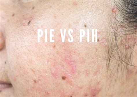 Pie An Pih Acne Marks Whats The Difference Treatments Banish