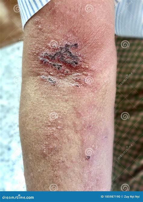 Shingles Or Herpes Zoster Infection In Left Arm Of Southeast Asian