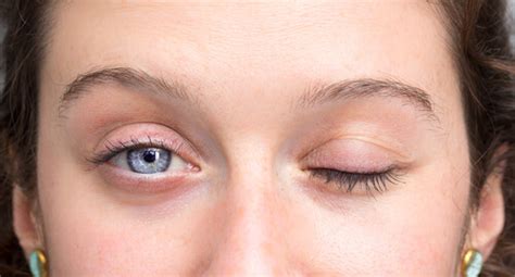 14 Things That Cause Droopy Eyelid Page 4 Of 15