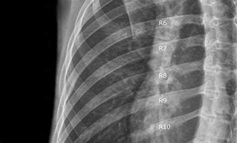 Ribs Radiographic Anatomy Oblique View X Ray Pinterest Anatomy
