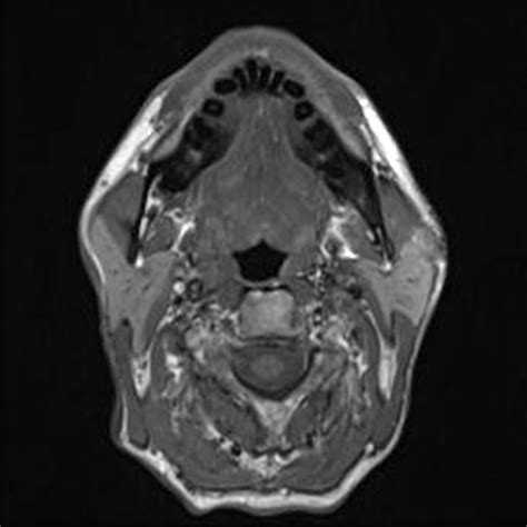 Tonsillar Squamous Cell Carcinoma Radiology Case