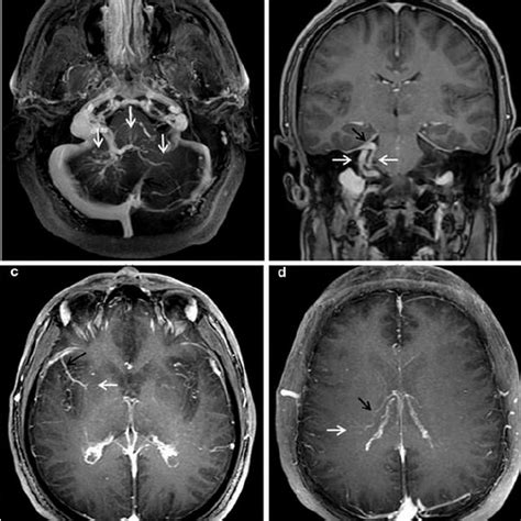 A Developmental Venous Anomaly Dva Located In The Deep Subcortical