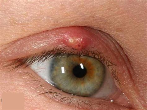 Pimple On Eyelid Types Causes And How To Treat Them