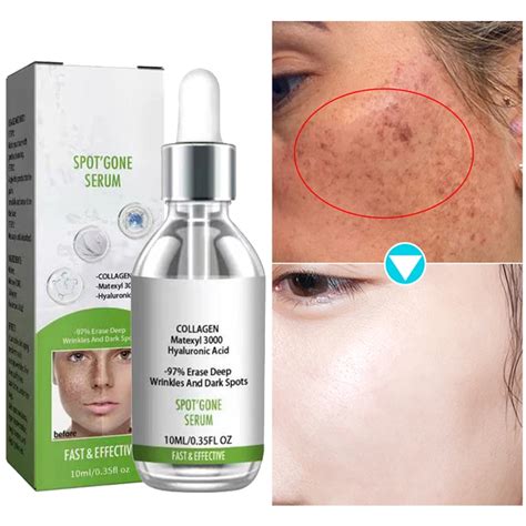 Freckles Removal Essence Remove Facial Spots Skin Dark Spot Remove