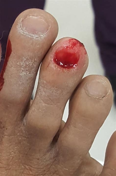 Swollen Painful Toe Big Toe Or Small Toes Causes And Best Treatment