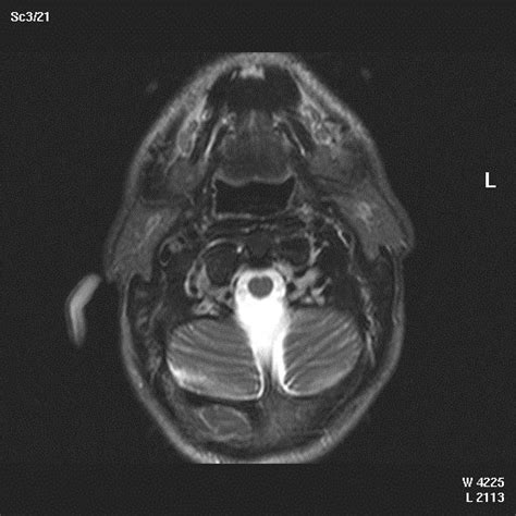 Axial Mri Section Three Weeks After Uppp Shows Asymmetry Of The Pharynx