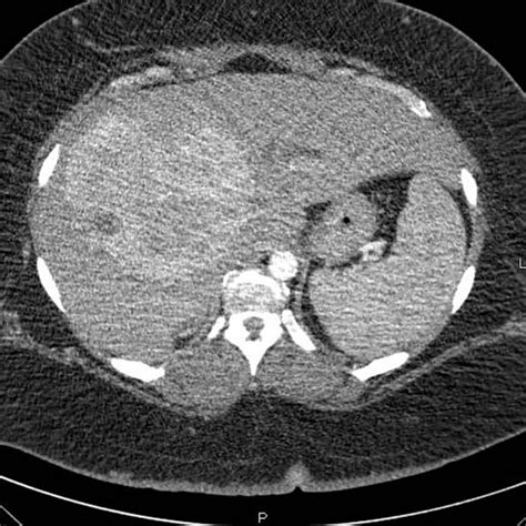 A Triple Phase Helical Ct Scan Shows A 14 Cm Hypervascular Mass
