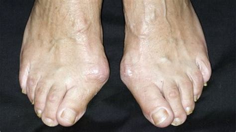 Funny pictures of camels, toes, and random ladies. Bunions - family not footwear to blame - BBC News