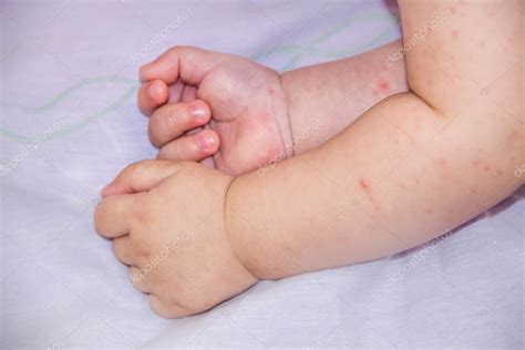 Baby Hand Skin Rash Allergy Red Spot Cause Mosquito Bite Stock Photo By