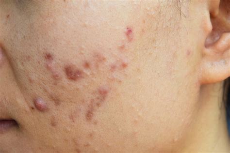 What Is Nodular Acne