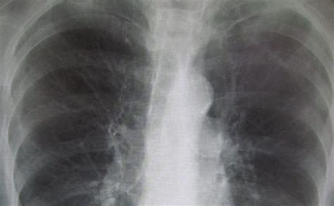 Blood Test Shows Potential For Early Detection Of Lung