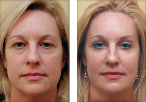 Remove Wrinkles With 5 Easy And Simple Steps Fitneass