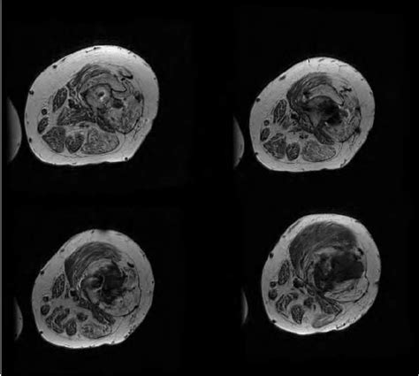 Axial T1w Mri Scans Through The Tumor Same Patient As In Figure 18