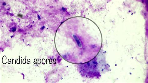Candida Spores In Cytology Youtube