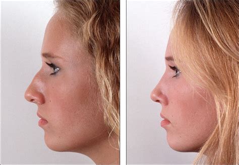Rhinoplasty Rhinoplasty Nose Job Plastic Surgery
