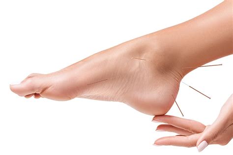 Dry Needling The Footcare Clinic