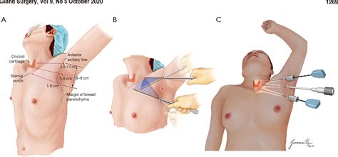 Figure From Novel Robot Assisted Thyroidectomy By A Transaxillary Gas