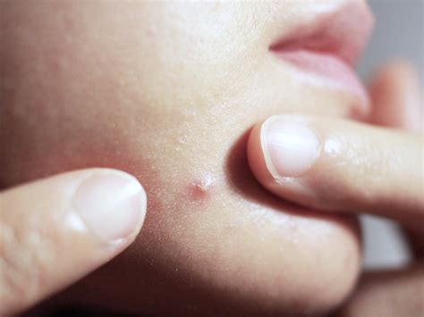 Heres Whats Actually Inside Your Pimples Business Insider