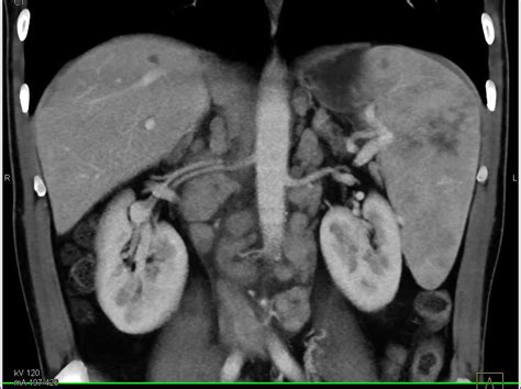 Lymphoma With Splenic Involvement And Extensive Adenopathy