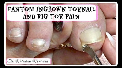 👣ingrown Toenail Big Toe Pain Remedy Pedicure Tutorial 👣 Youtube