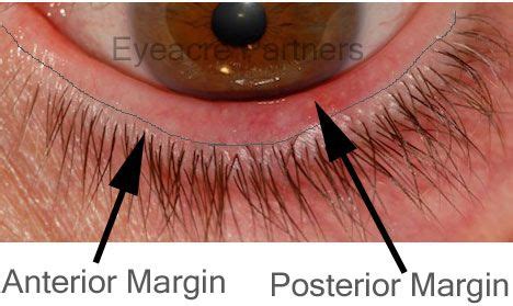 Blepharitis is a chronic condition of inflamed eyelids that causes the eyes to become itchy and red. ANterior vs Posterior Blepharitis | Blepharitis, Eye care ...