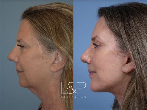 Revision Facelift Neck Lift Brow Lift And Lower Bleph