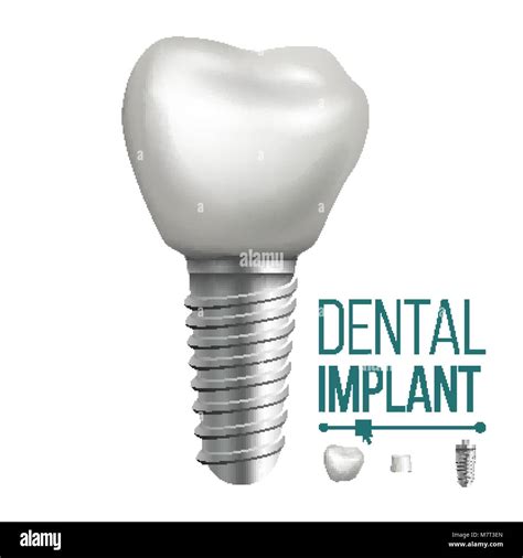 Vector De Implantes Dentales Molar Dientes Humanos Clínica Dental