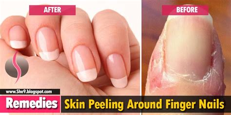 Skin Peeling Around Finger Nails Causes Consequences And 10 Home