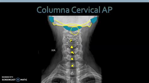 Anatomía Radiológica Columna Cervical Youtube
