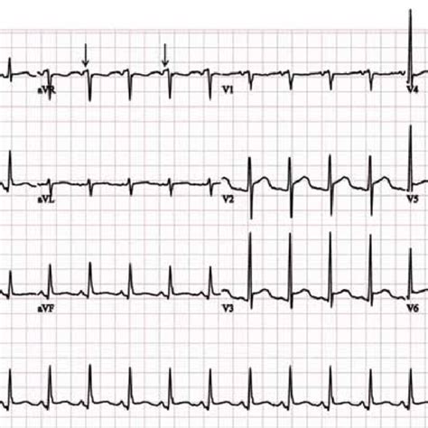 Ecg Shows Sinus Rhythm With Concave St Elevation Arrows In Leads