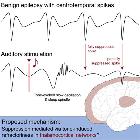 Disordered Brain Activity In Rolandic Epilepsy Can Be Influenced By