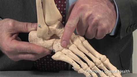 Osteoarthritis Of The Mid Foot Youtube