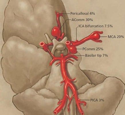 Aneurysm Of The Posterior Inferior Cerebellar Artery Occurrence And Prognosis
