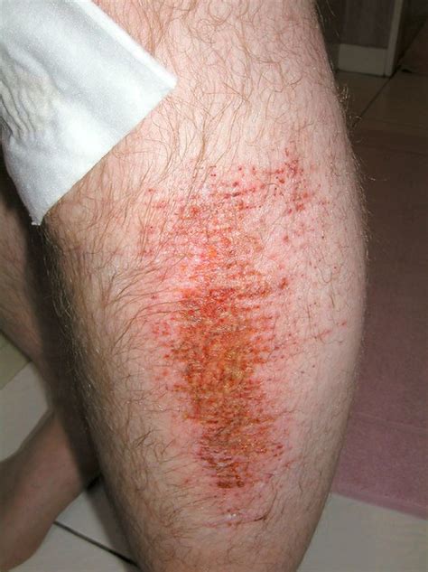 Leg Infection 01 Flickr Photo Sharing