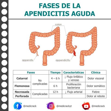Apendicitis Clasificaci N Y Tipos Epidemiolog A Fisiopatolog A The The Best Porn Website