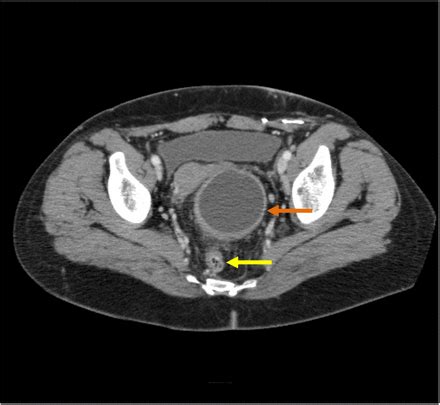Rectal Duplication Cyst In An Adult With A History Of Imperforate Anus