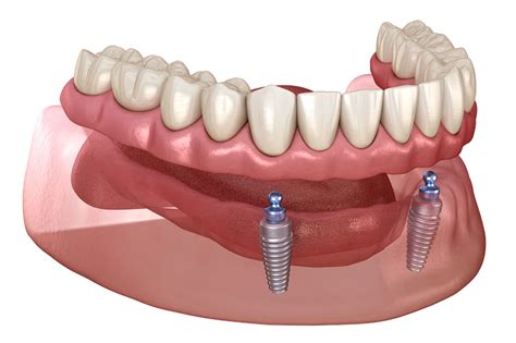 Implant Supported Overdentures Dr Dental Clinics