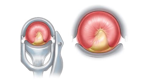 Question 2 Cervicitis Question Bank National Std Curriculum