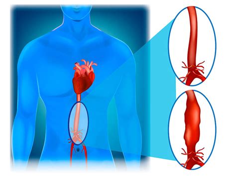 Aortic Aneurysm What Is It Causes Classification Booking Health