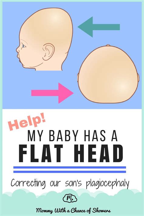 Our Son Was Diagnosed With Plagiocephaly Flat Head Syndrome We Tried