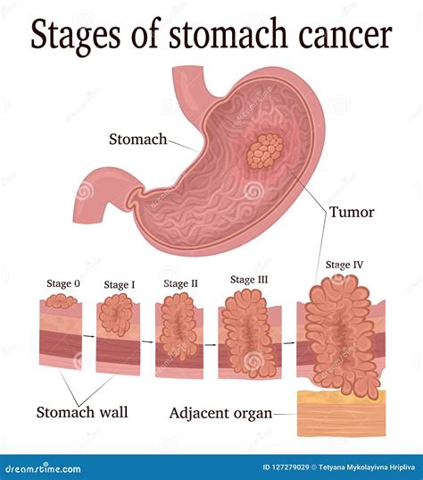 Stages Of Stomach Cancer Stock Vector Illustration Of Gastric