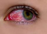 Images of Medicated Colored Contact Lenses