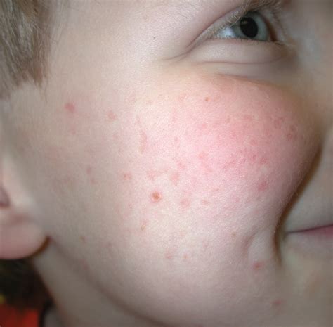 Collection 93 Images Keratosis Pilaris On Face Pictures Full Hd 2k 4k