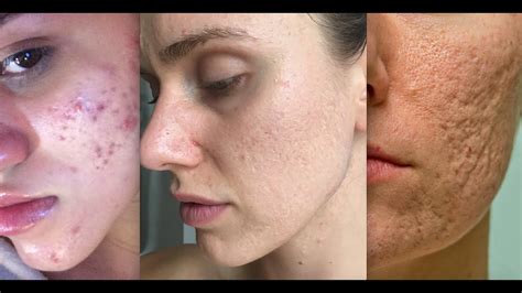 Types Of Acne Scars Youtube
