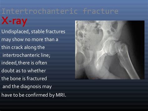 Intertrochanteric Fracture