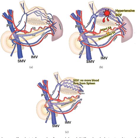 Pdf Splenic Artery Embolization For The Treatment Of Gastric Variceal