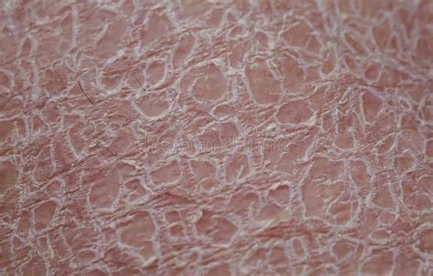 Texture Of Women`s Skin Close Up Covered With Small And Large Cracks