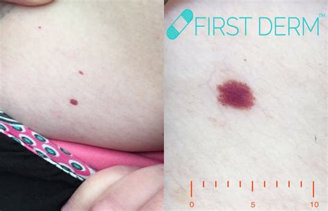 Red Spots On Skin Pictures Causes Treatment Online Dermatology