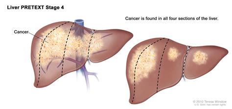 These might include high fever, swollen face, finger clubbing, wheezing and chronic hoarseness. Symptoms of Liver Cancer Stage 4 - CancerOz