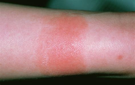 Contact Dermatitis Wristwatch Allergy Photograph By Dr P Marazzi